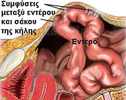 Ρομποτική Χειρουργική Αποκατάσταση Κηλών