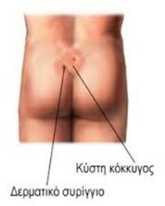 Κύστη Κόκκυγος
